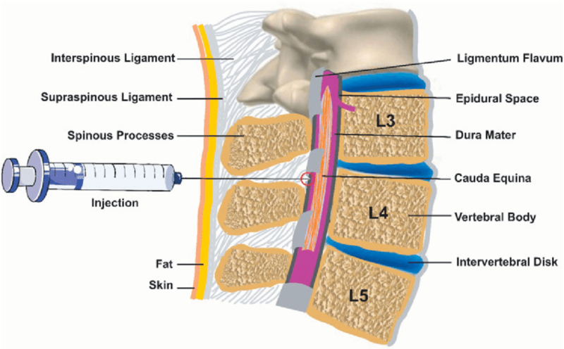 epidural site pain years later